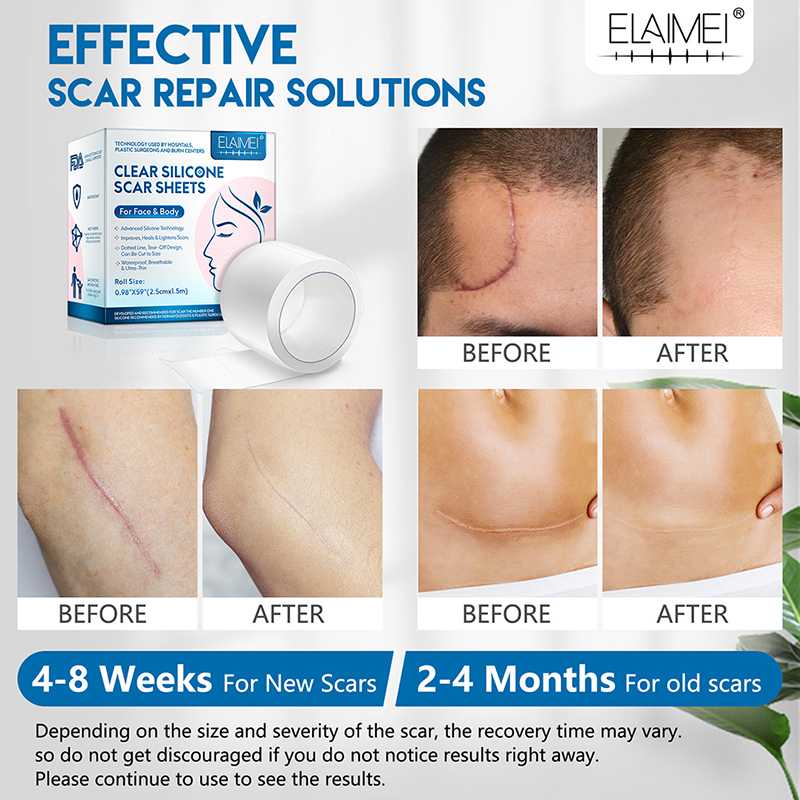 2.5CM * 1.5M Surgery Scar Removal Sticker Patchs Silicone Gel Scars