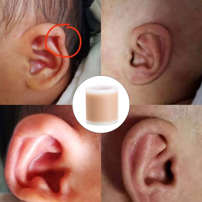 Silicone Baby Ear Corrector Infant Protruding Ears Correction 5 x 100cm For SN❤ - Picture 12 of 12